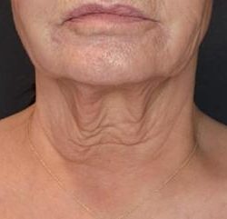 Sofwave Before & After Patient #1606